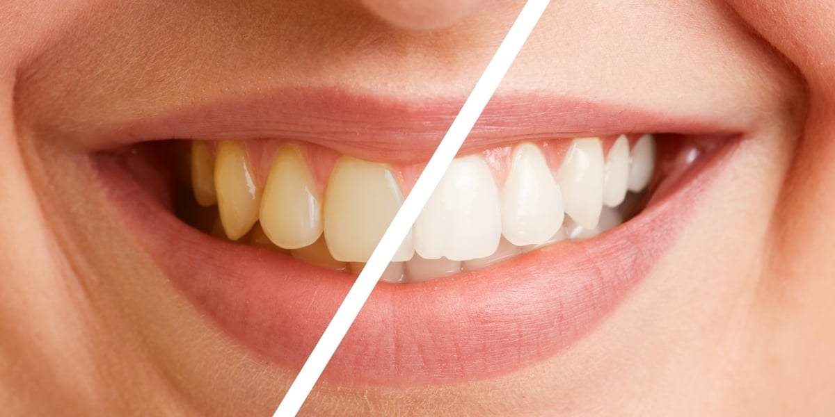 Dientes blancos: el secreto para una sonrisa saludable y radiante